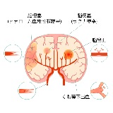脳血栓